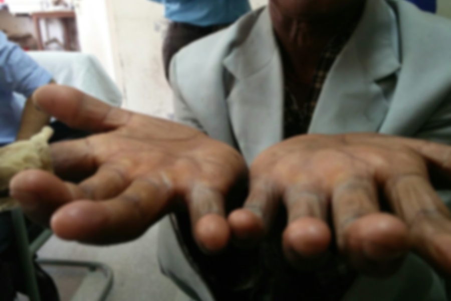 देशभर कुष्ठरोगका २१ सय बिरामी फेला, काठमाडौँमा मात्रै ११० जना