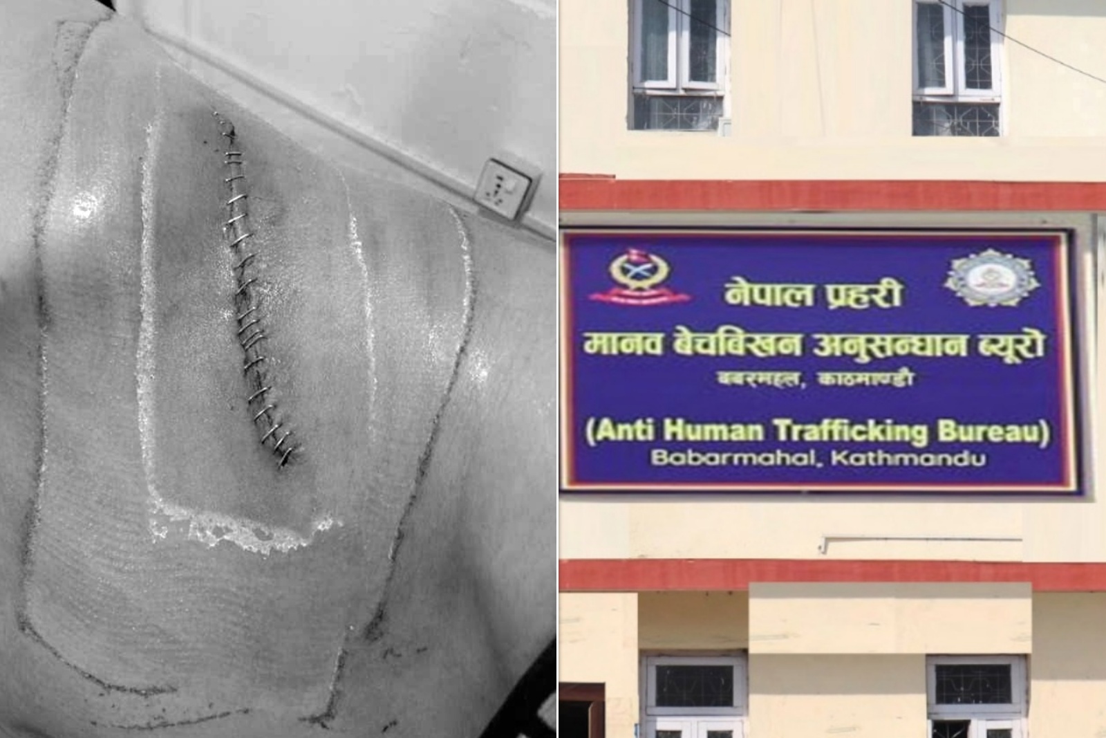 मानव अंग बेचबिखनको ‘र्‍याकेट’ चलाइरहेका भण्डारीः जसले १०० भन्दा धेरै व्यक्तिको मिर्गौला बेचे