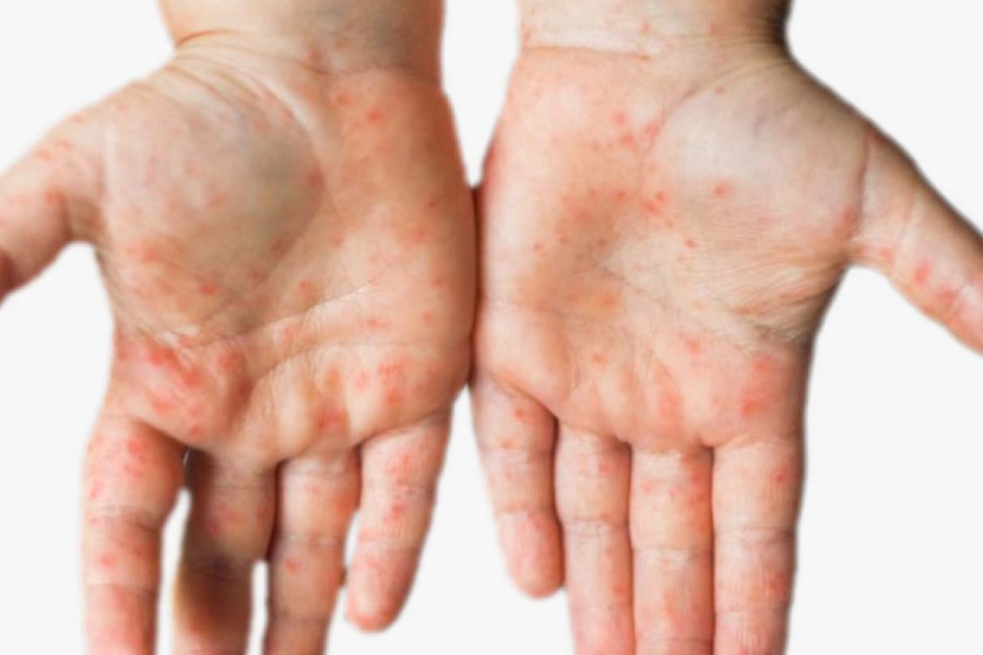 कुष्ठरोग दिवस मनाइँदै: मधेशमा सबैभन्दा धेरै कुष्ठरोगी
