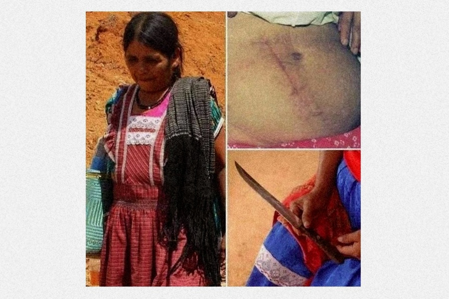 पेरेज साथमा पेट चिर्न प्रयोग भएको चक्कु र पेटको घाउको तस्वीर।