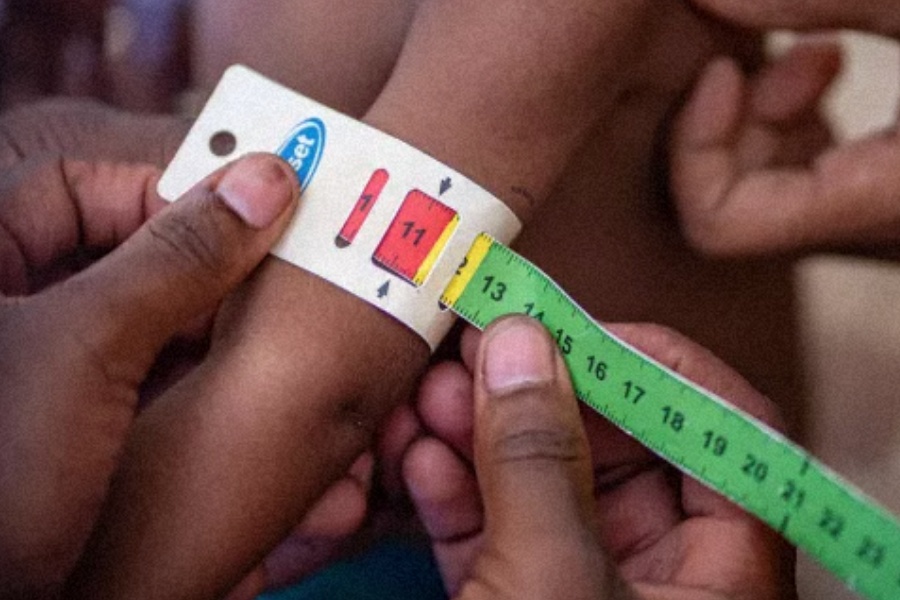 बाँकेका सबै स्थानीय तहमा कुपोषणका बालबालिका