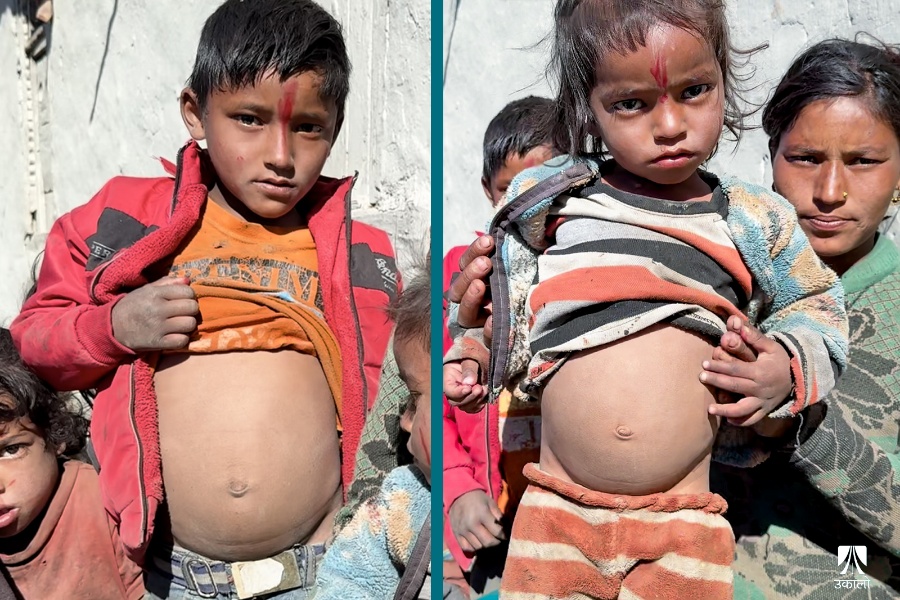 हजारीका छोरा र छोरी दुवै कुपोषित छन्।